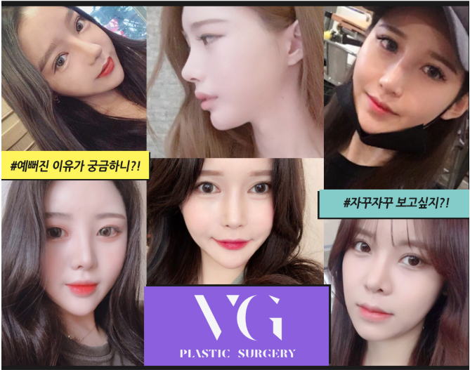 베리굿성형외과 엑설런트 코재수술! 다시 살아나는 미모의 시작~ 강남역성형외과 관련 이미지 8