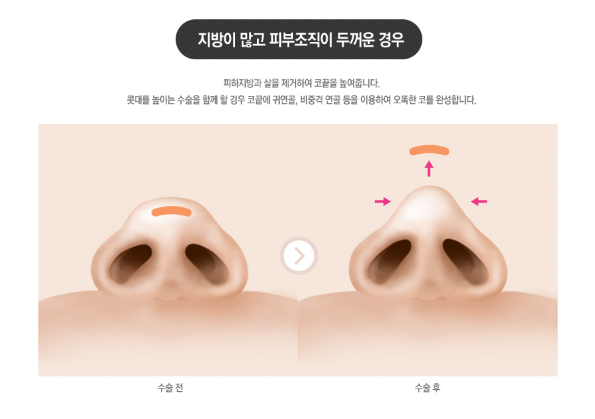 [ 베리굿성형외과 ] 베일듯한 코라인 베리굿 복코 찐 전후비교 관련 이미지 5