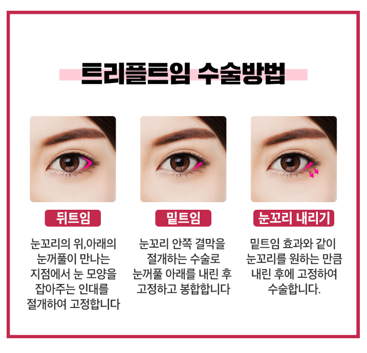 시원한 눈매? 베리굿 트리플 트임 관련 이미지 3