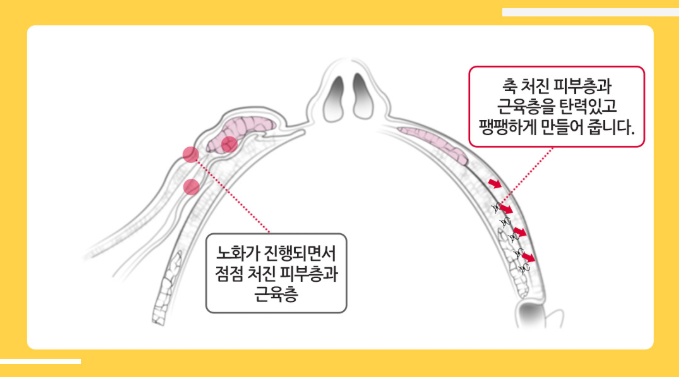 풀페이스리프팅 베리굿성형외과에서 동안얼굴 완성~! 관련 이미지 5