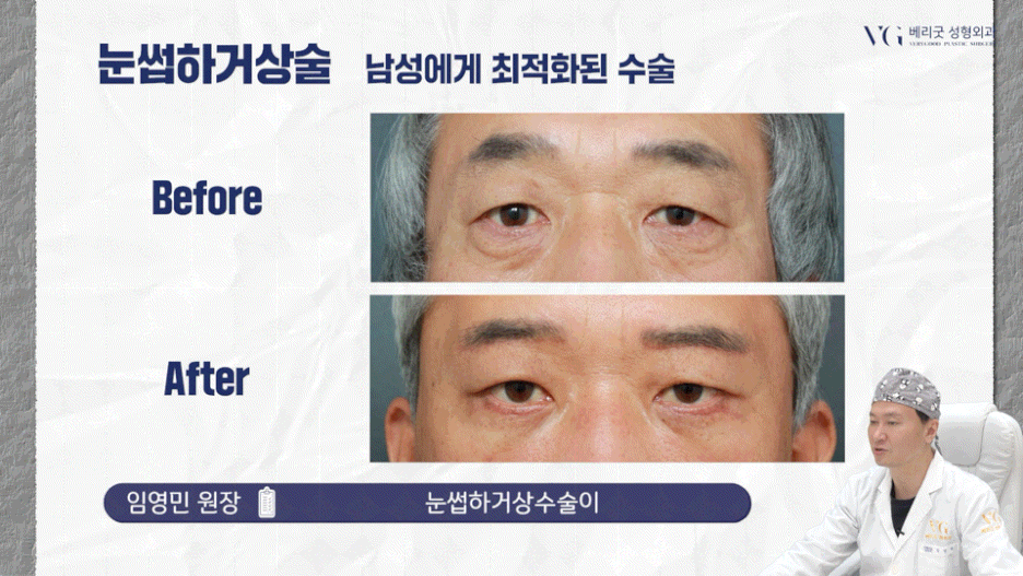 강남중년눈성형 잘하는곳 , 상안검 하안검 눈썹하거상술종류 진행방법 궁금하다면 관련 이미지 24