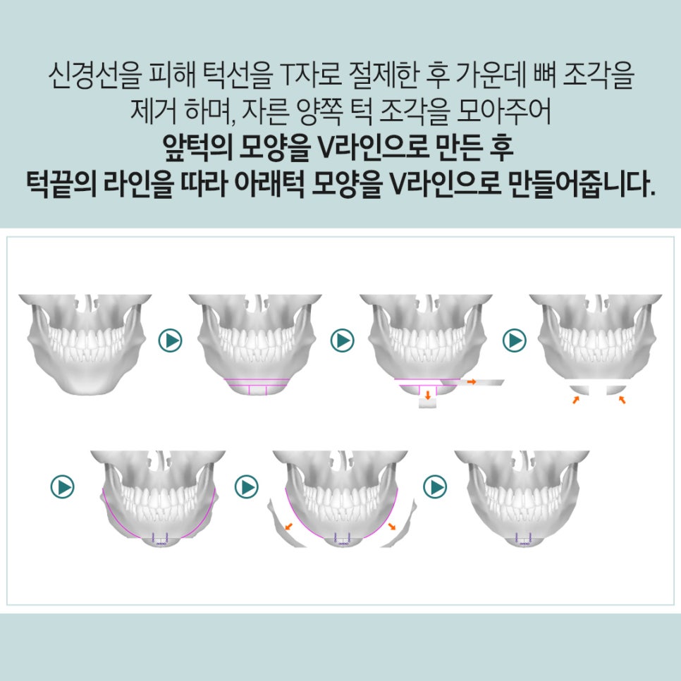 강남역 윤곽성형 베리굿성형외과👨&zwj;⚕️안면윤곽 전문의 임영민대표원장님💖 관련 이미지 7