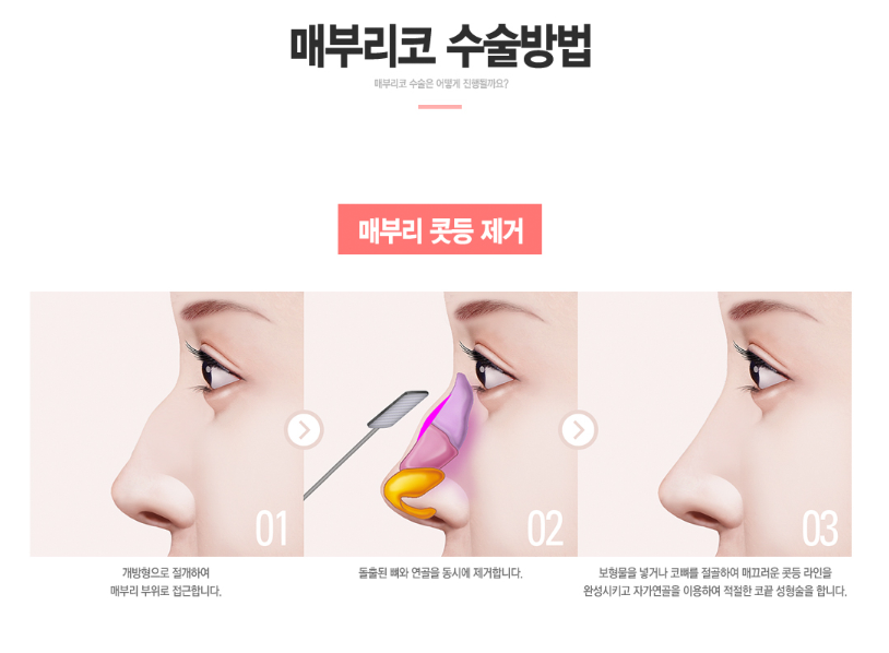 매부리코, 코성형 유형에 맞게 수술하자 관련 이미지 5