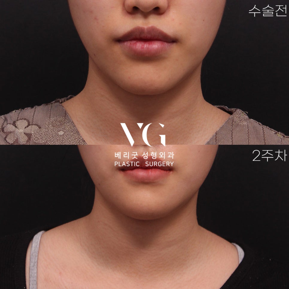 VERY GOOD LINE✨ V라인 턱끝축소 REAL전후 관련 이미지 5