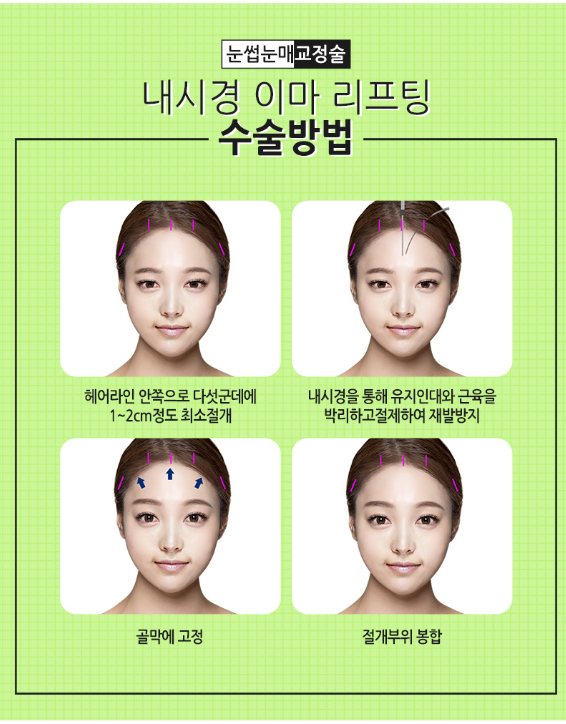 베리굿성형외과에서 이마리프팅하고 어려보이고 또렷해보이는 인상으로 change! 관련 이미지 4