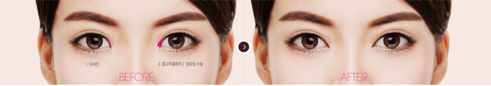 트임성형 시원하고 또렷한 눈매로 개선 관련 이미지 2