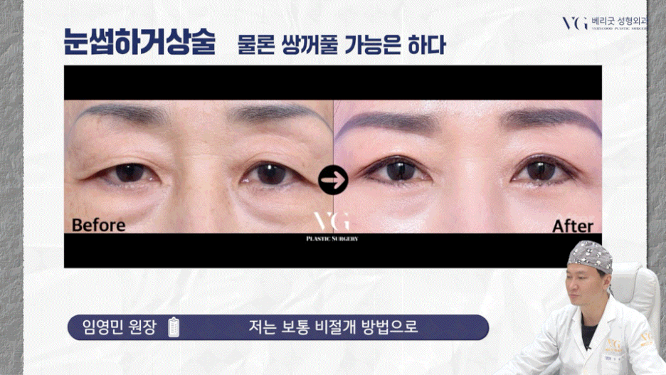 강남중년눈성형 잘하는곳 , 상안검 하안검 눈썹하거상술종류 진행방법 궁금하다면 관련 이미지 26