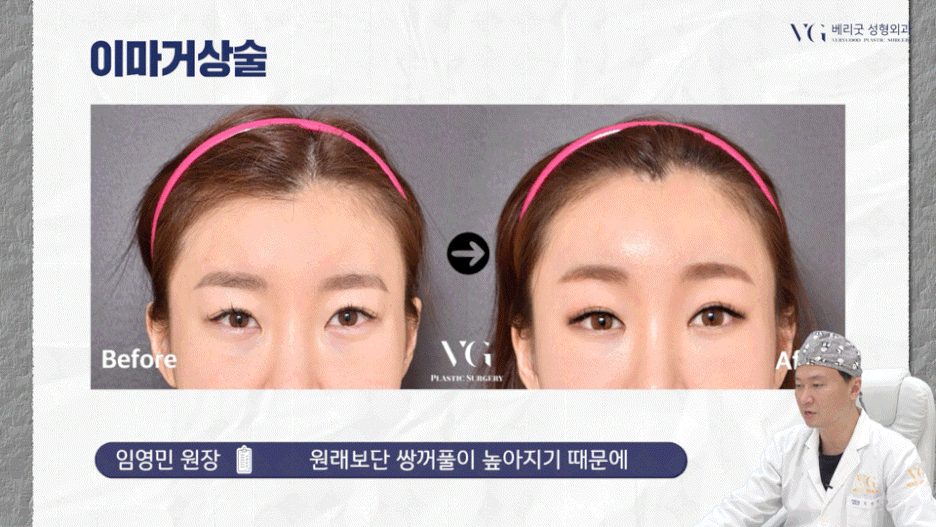 강남중년눈성형 잘하는곳 , 상안검 하안검 눈썹하거상술종류 진행방법 궁금하다면 관련 이미지 41