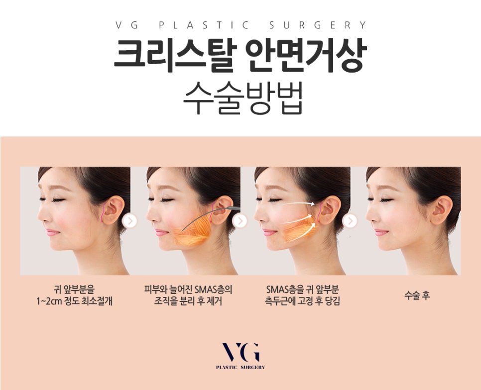 안면거상 가격 / 안면거상 후기 관련 이미지 3