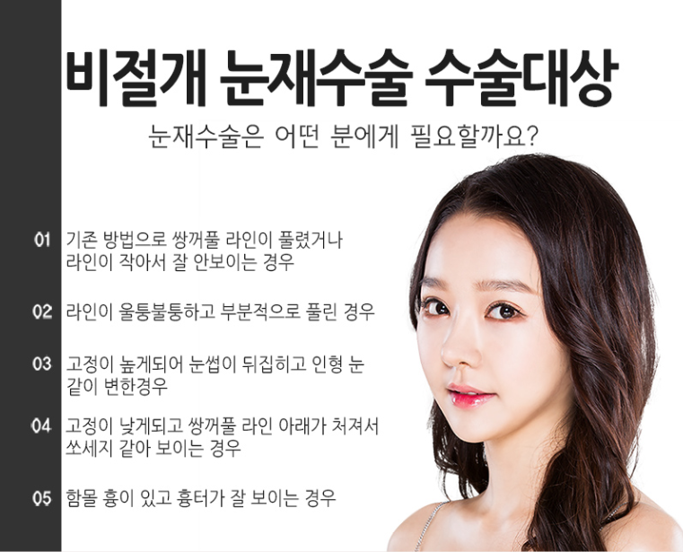 나의 마지막 눈성형 쌍꺼풀재수술! 어디에서 해야할까?? 관련 이미지 4