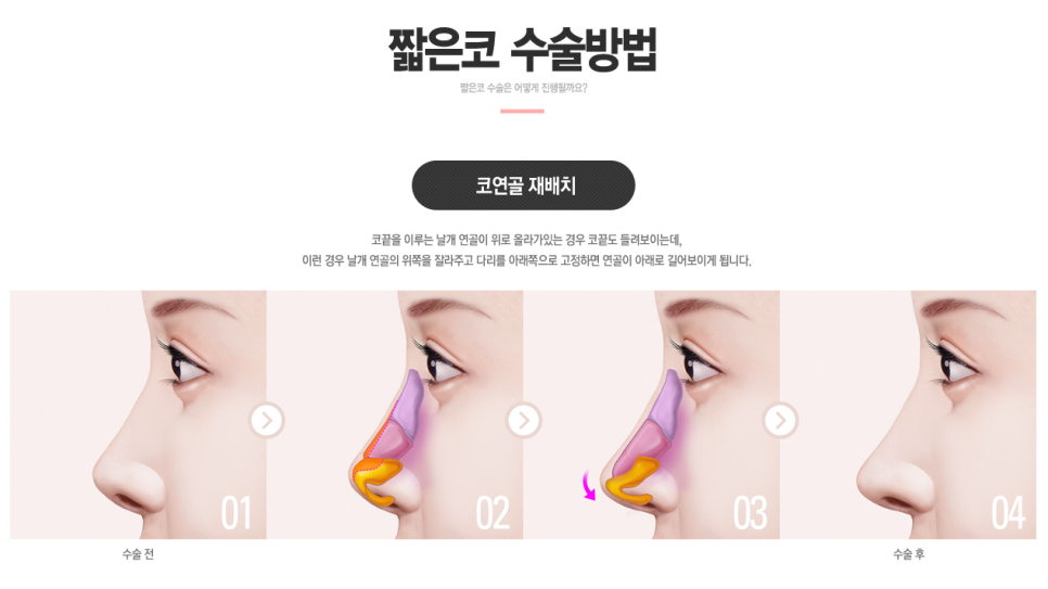 짧은 첫코성형도! 구축된 코재수술도! 베리굿성형외과✨ 관련 이미지 5