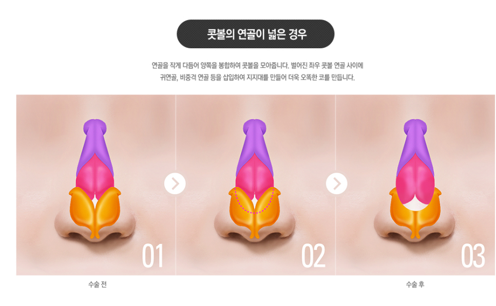 #복코성형 #복코수술 역시😘 #베리굿성형외과 관련 이미지 3