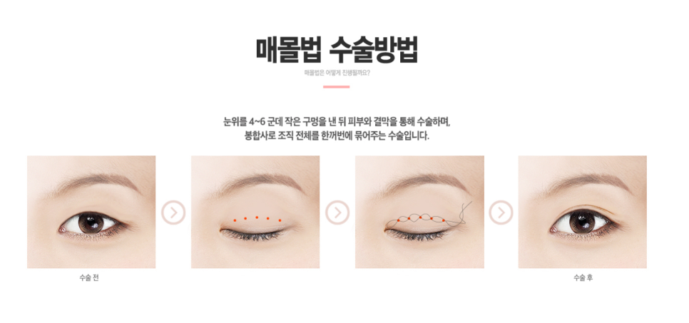강남쌍꺼풀수술성형외과 , 나한테 맞는 수술방법 디자인으로 눈성형 성공하려면 관련 이미지 5