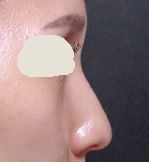 첫코수술 코끝수술 비중격교정술 하비갑개절제술 베리굿성형외과 전후후기 관련 이미지 1