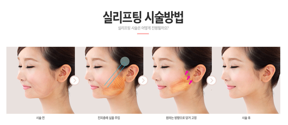 베리굿성형외과💖실리프팅으로 UP! 젊음은 GET! 관련 이미지 3