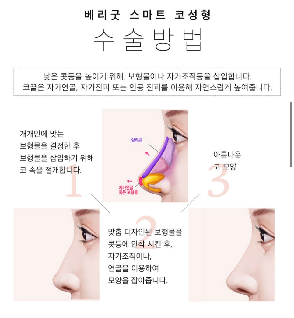 이제 코성형도 스마트하게✨ 베리굿 비개방코성형💖 관련 이미지 4
