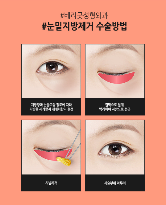 눈밑지방제거로 눈밑은 매끈하고 환하게! 관련 이미지 5