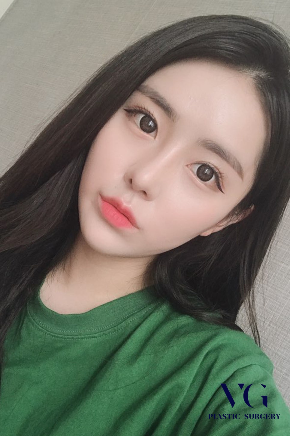 자연유착 쌍꺼풀수술, 마치 내 것 같은 자연스러움 관련 이미지 2