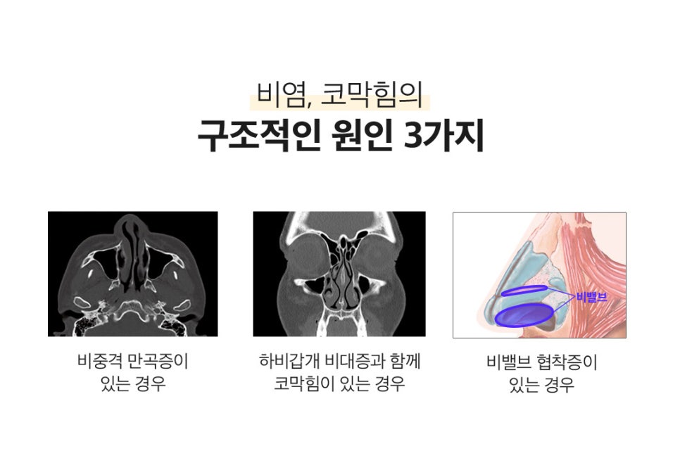 비염코성형 원인 파악부터 비용까지 관련 이미지 3