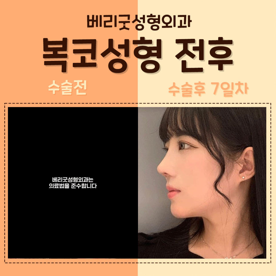 #복코성형 #복코수술 역시😘 #베리굿성형외과 관련 이미지 6