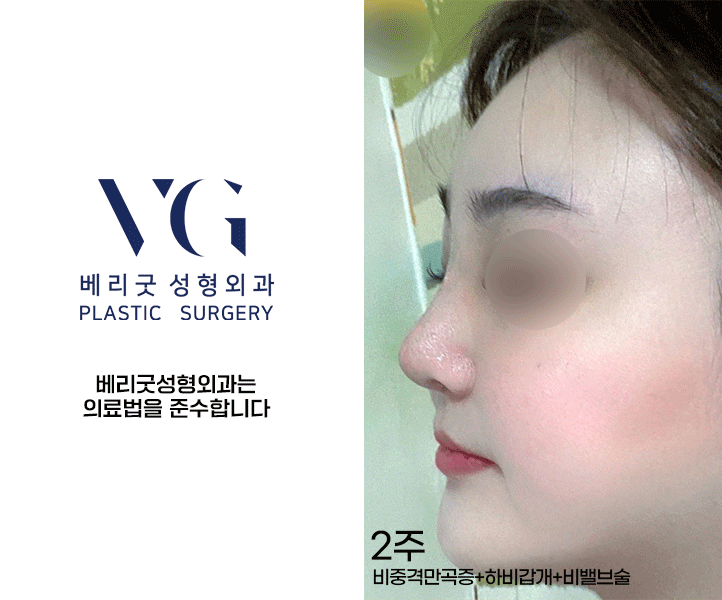 베리굿 비염코성형✨비염수술과 코성형을 동시에? 관련 이미지 9