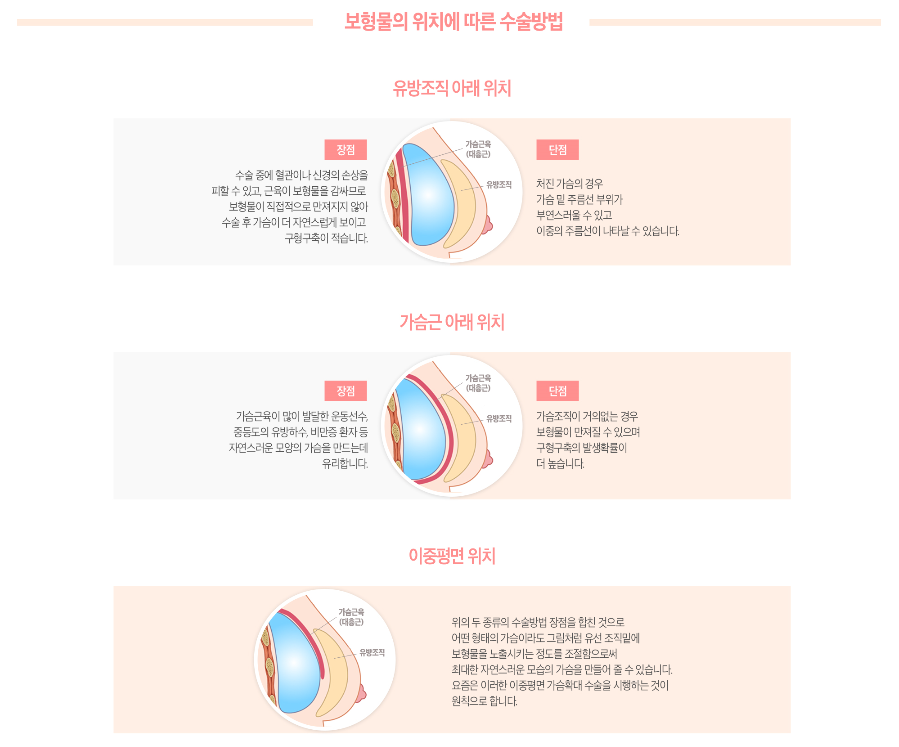 가슴성형비용 자연스러운 움직임과 촉감으로 관련 이미지 4
