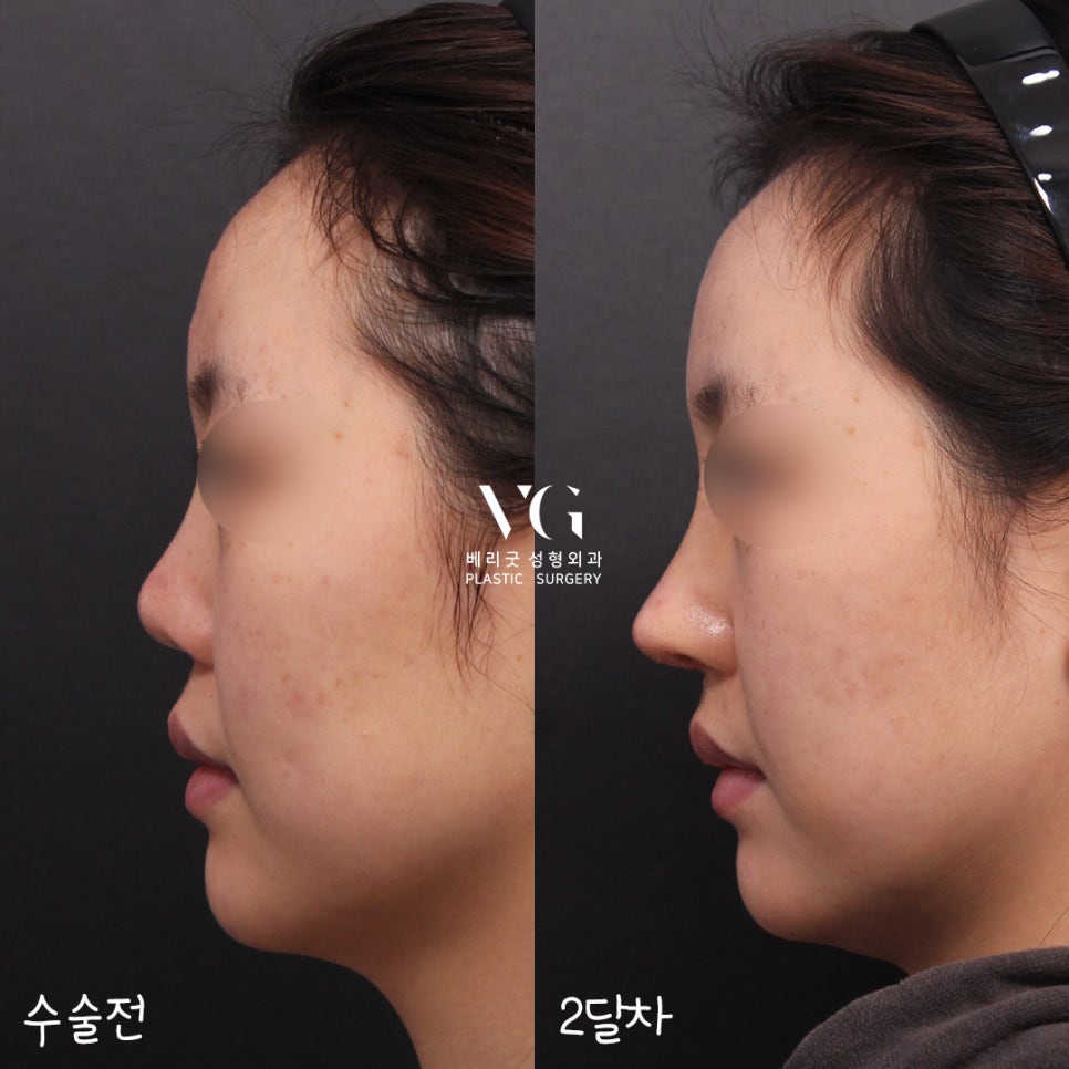 짧은 첫코성형도! 구축된 코재수술도! 베리굿성형외과✨ 관련 이미지 3