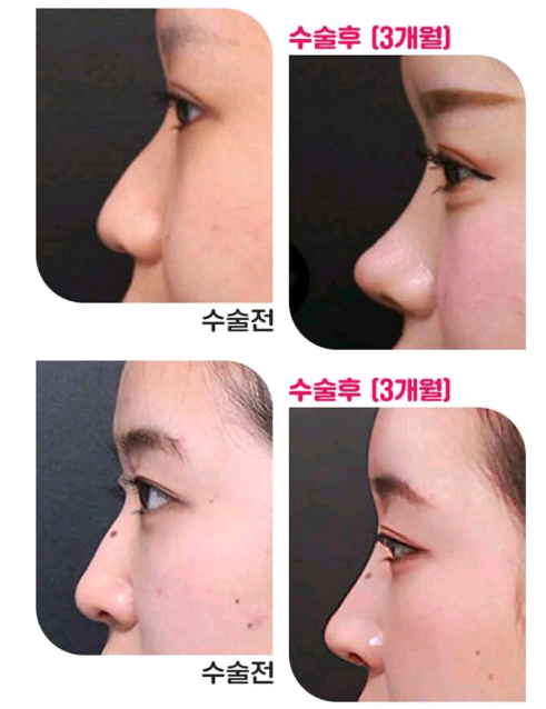 베리굿성형외과-MZ코,내돈 내산 코성형후기 mz세대의 유행하는 코성형은? 코성형부작용 1일차,3일차,1달차,전후후기 관련 이미지 5