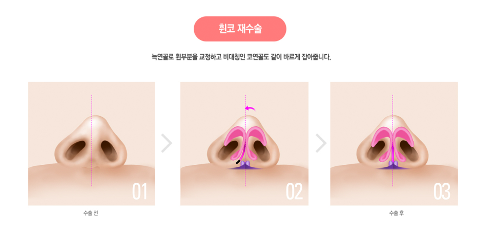 코끝도 베리굿💯#자가늑연골 #반버선 #직반버선 #베리굿성형외과 관련 이미지 6
