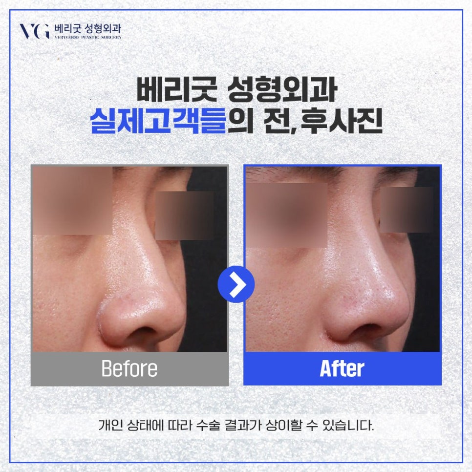코수술 후기 모음 zip. #1｜베리굿성형외과 8월 코성형 주간지 관련 이미지 4