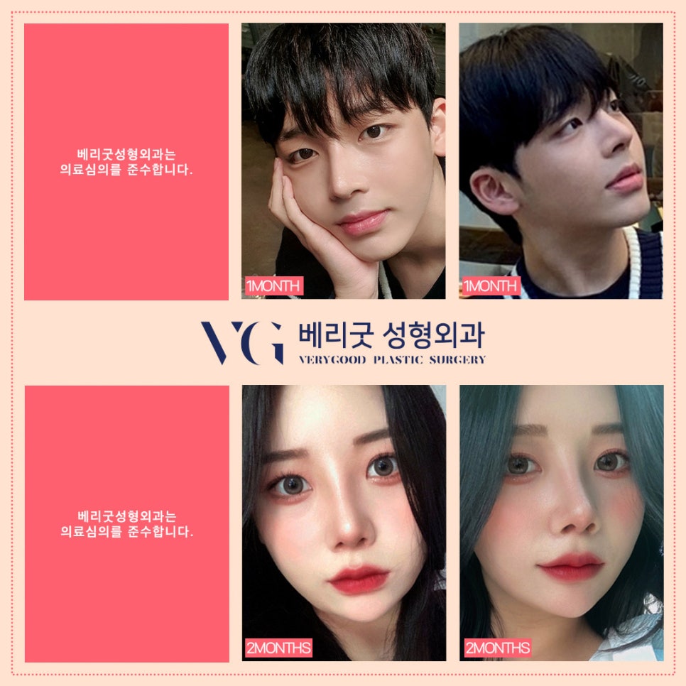 주먹코 큰코 복코!! 베리굿성형외과에서 복코 교정하자 관련 이미지 1