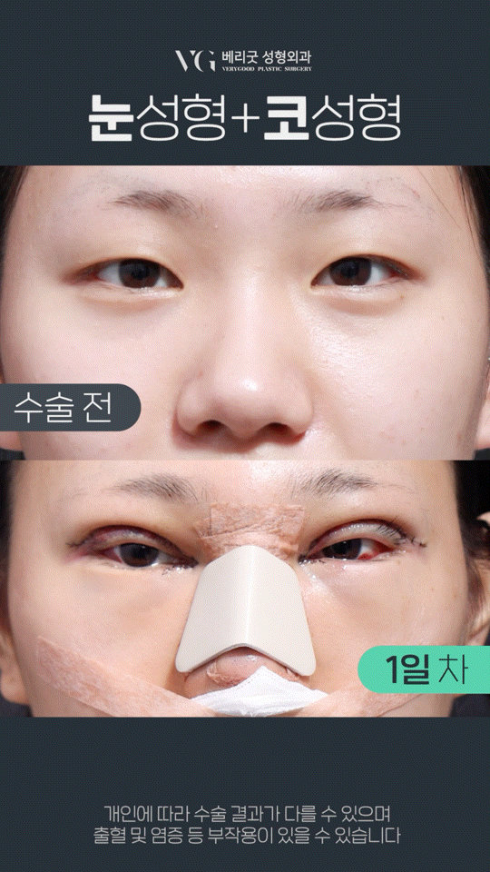 눈코수술후기 , 붓기 쌍수 코성형 회복기간 궁금하다면 관련 이미지 12