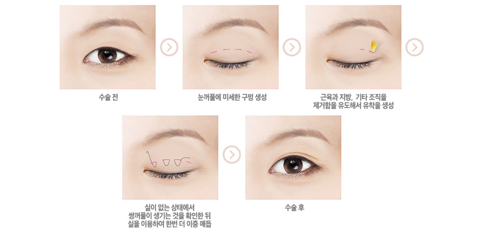 아름다움을 위한 시작, 베리굿성형외과 눈 성형(자연유착) 관련 이미지 4