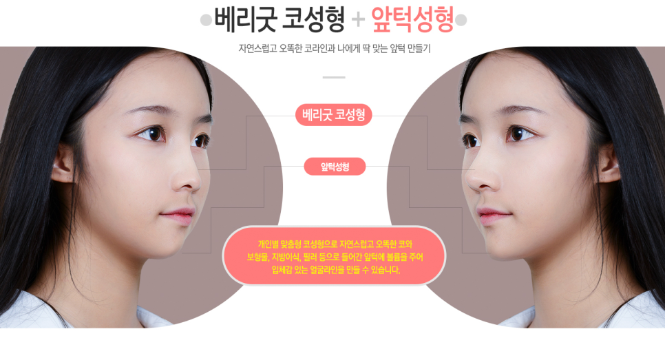 교정 없이! 발치 없이! 코성형으로 돌출입교정하자 ❤베리굿성형외과❤ 관련 이미지 6