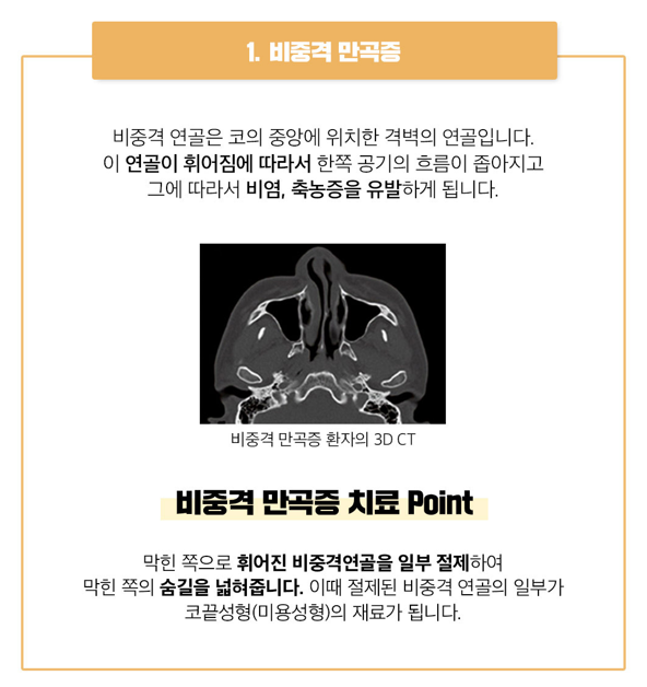 베리굿 비염코성형❤기능과 미용을 동시에?!😍 관련 이미지 5