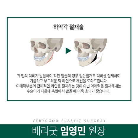 안면윤곽 어떤 종류가 있을까? 장점과 주의사항 알아보기 관련 이미지 7
