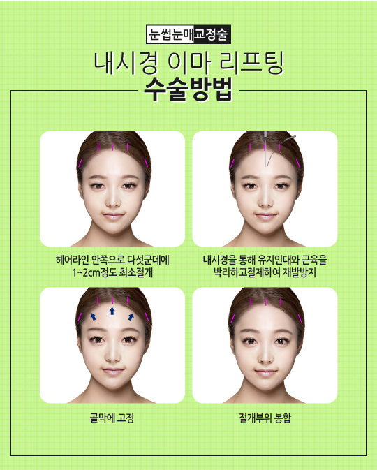 내시경 이마리프팅으로 주름개선과 또렷한 눈매를 한번에! 관련 이미지 3