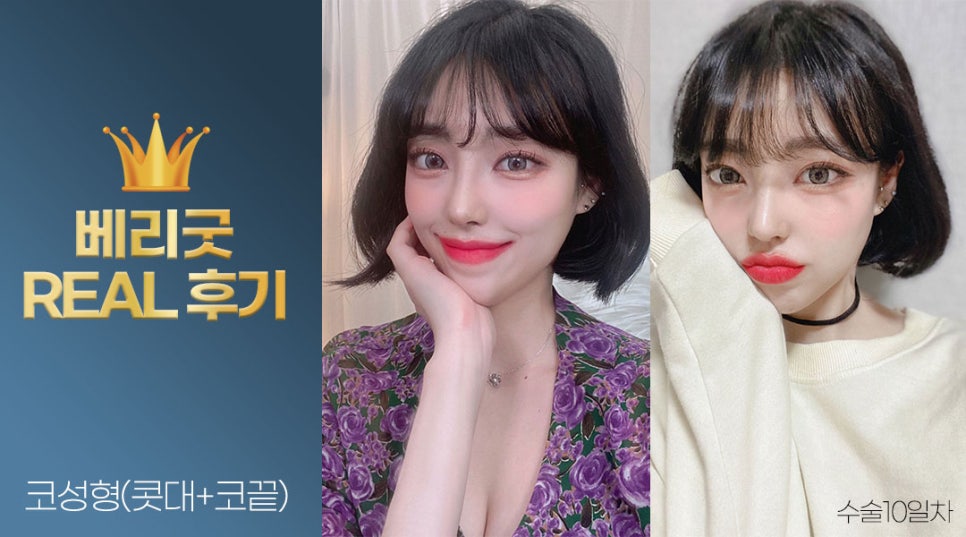 내가 예뻐진 이유❣ 베리굿성형외과 강남역 코성형 리얼후기✨ 관련 이미지 2