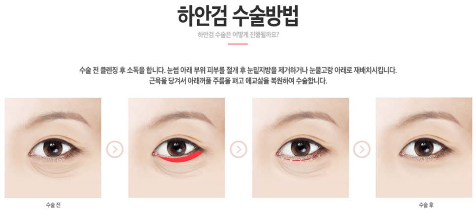 #베리굿성형외과 중년 눈성형(하안검), 그때 그 시절 나의 리즈로 시즌2 #임영민원장 #베리굿임영민 관련 이미지 5