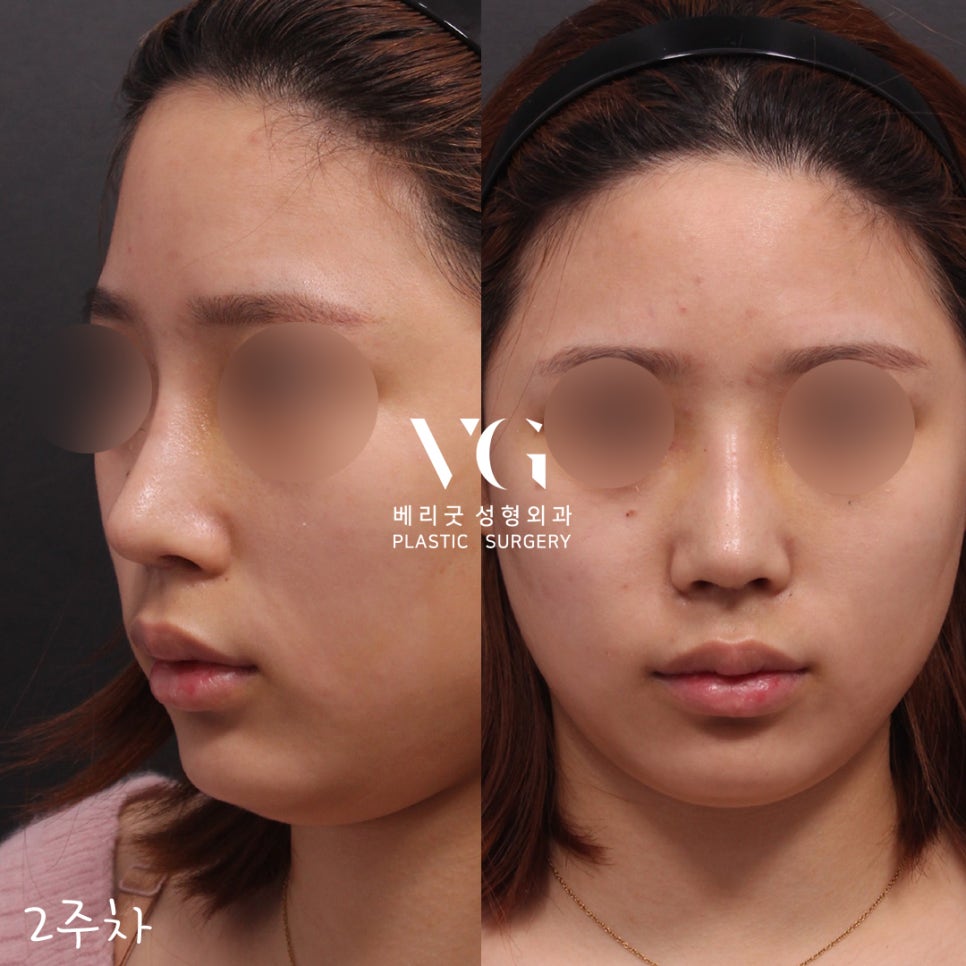 직반코성형전후💖베리굿성형외과 관련 이미지 4