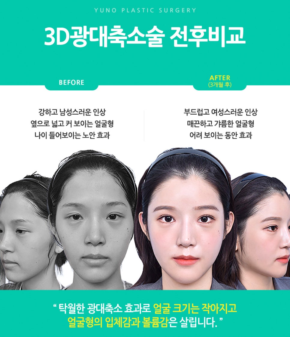 얼굴 작아지는법/ 베리굿성외과 3D광대축소술180만원 /강남역성형외과/강남역위치 관련 이미지 6