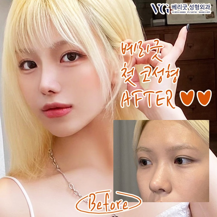 눈코수술후기 , 붓기 쌍수 코성형 회복기간 궁금하다면 관련 이미지 9