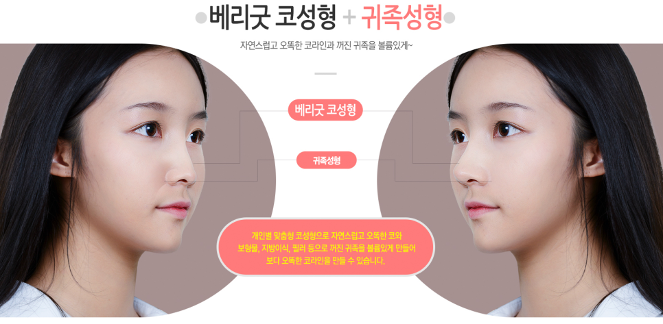 교정 없이! 발치 없이! 코성형으로 돌출입교정하자 ❤베리굿성형외과❤ 관련 이미지 5