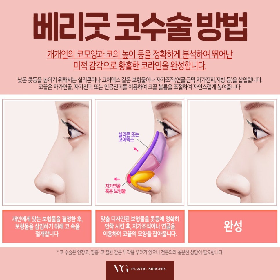 강남 코성형 잘하는 곳은? 낮은 콧대, 코끝 한번에 오똑한 라인으로 관련 이미지 5