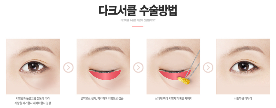 눈밑지방재배치 하고 환한 쌩얼로 자신있게! 관련 이미지 4