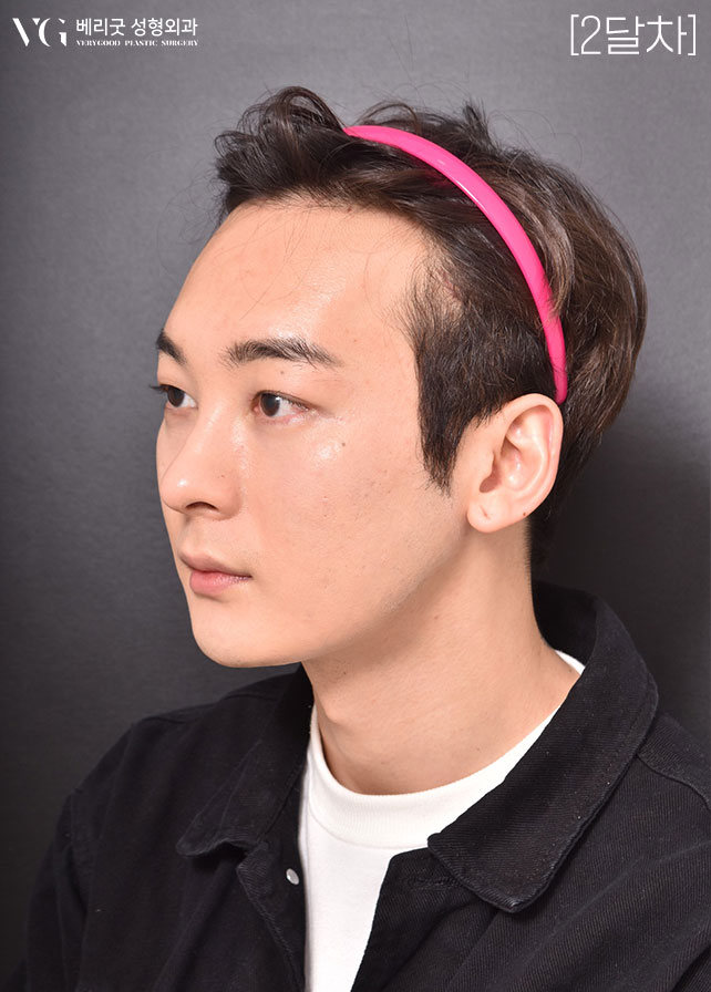 [베리굿성형외과]안면윤곽 리얼전후! 관련 이미지 15