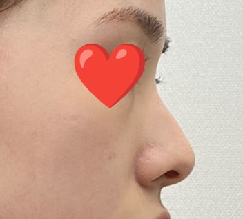Primary Rhinoplasty with Osteotomy, Dorsal Hump Correction, Nostril Lowering, Septoplasty, and Inferior Turbinate Resection | Very Good Plastic Surgery Before-and-After Review image 1
