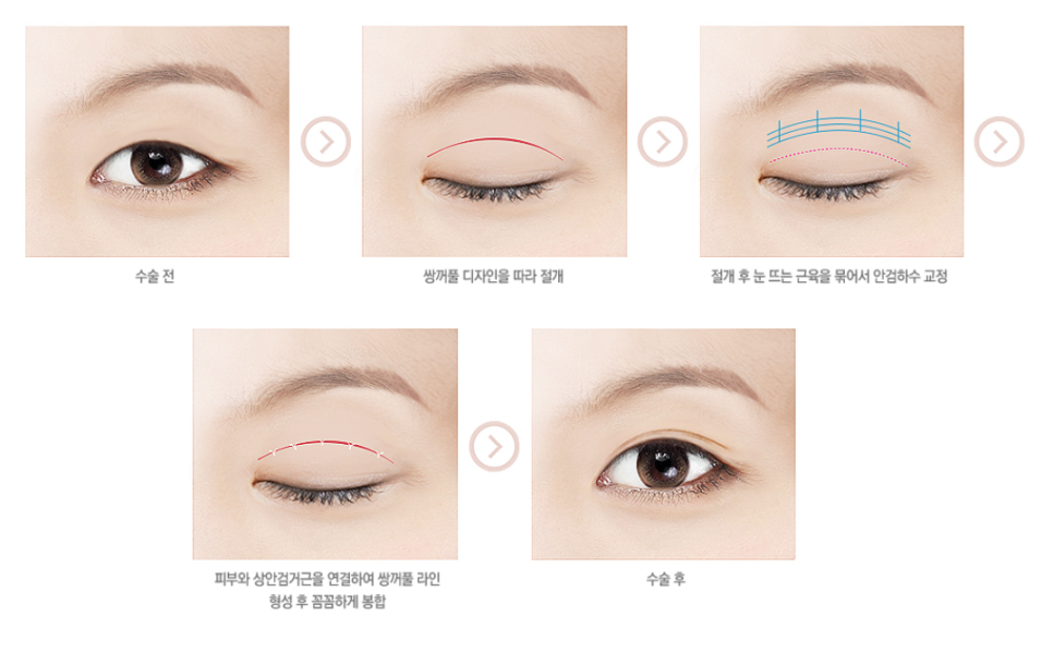 안검하수, 눈매교정으로 개선할수있다? 관련 이미지 4