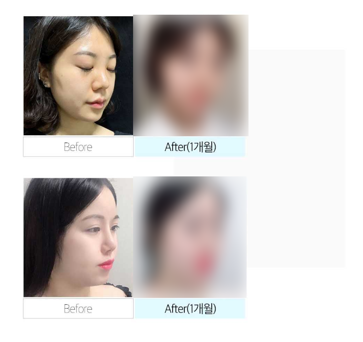 윤곽없이 v라인 얼굴지흡으로 완성! 관련 이미지 9