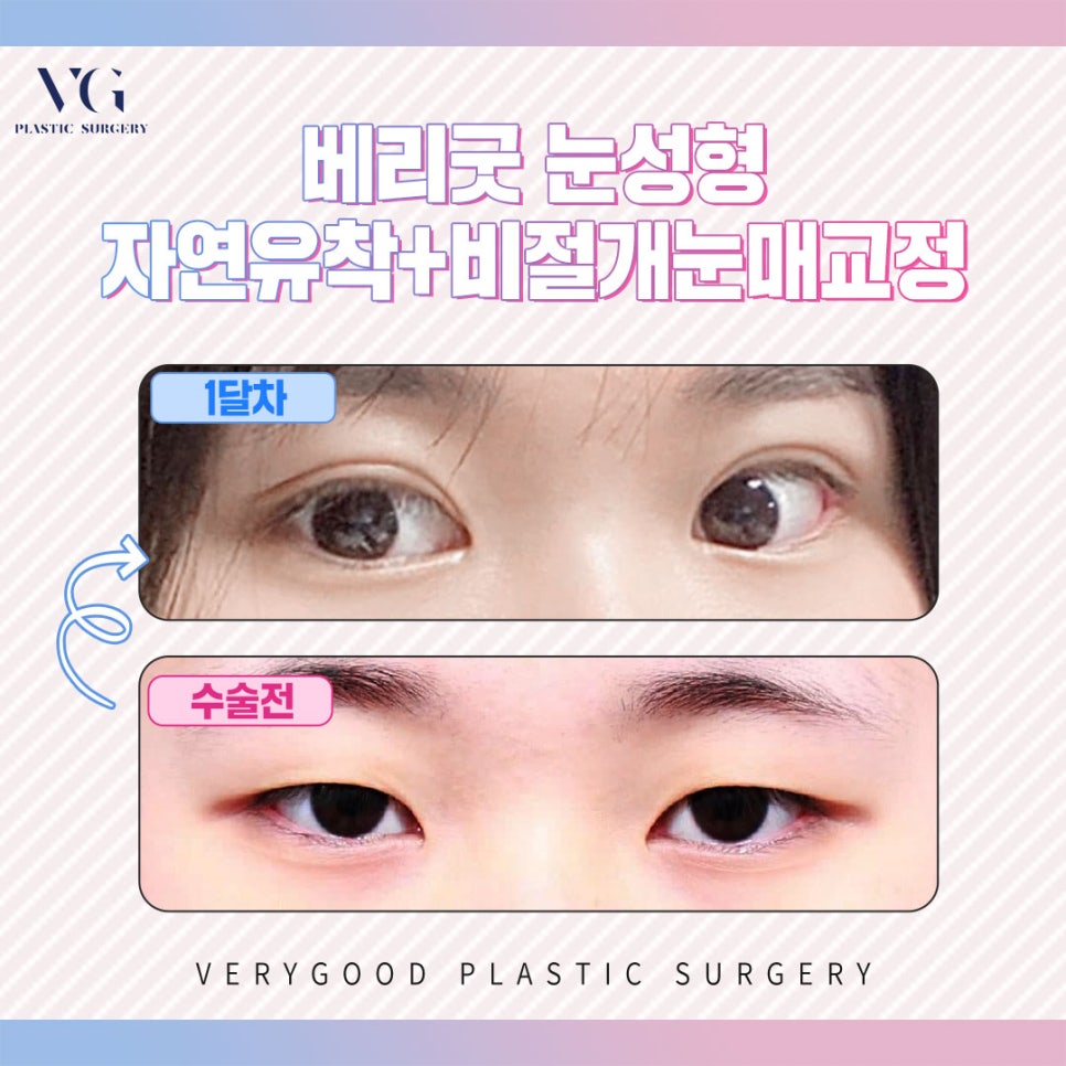 눈재수술도 베리굿하게😍베리굿성형외과 관련 이미지 7